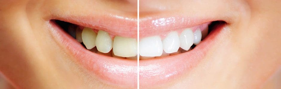 before and after teeth whitening